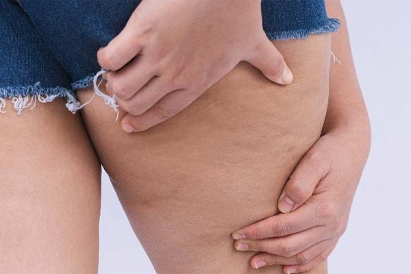 Leiden Sie unter Cellulite? Schauen Sie sich einfach diese Tipps an!